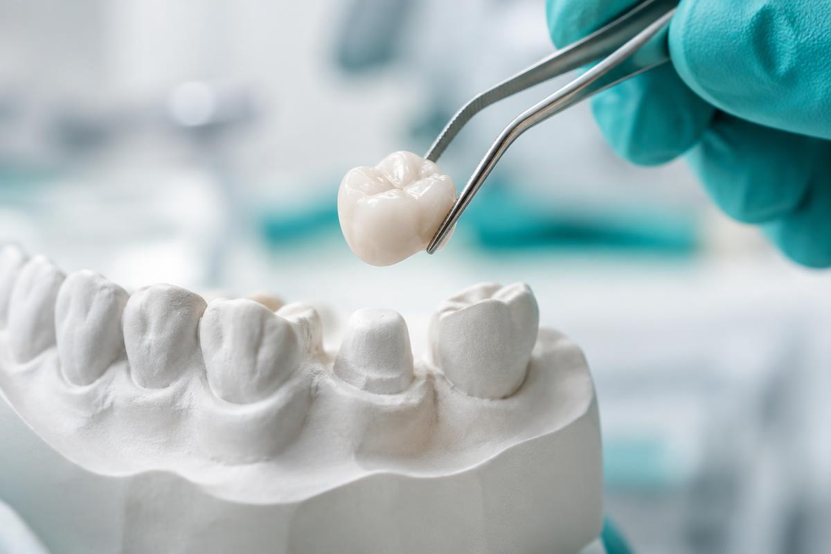 Capsula o corona dentale: qual è la differenza — trattamenti dentali di protesi nello studio dentistico DentalNet Care
