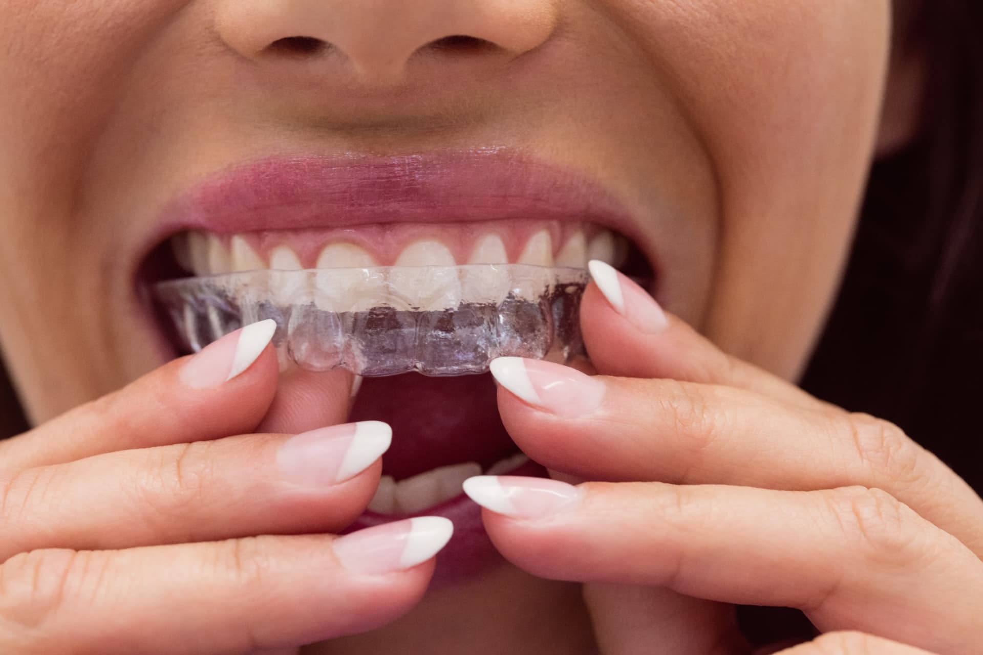 Ortodonzia invisibile: dettaglio clinico in uno studio partner DentalNet Care
