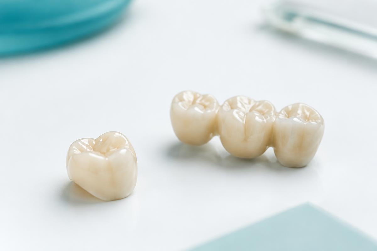 Corone in zirconio o metallo-ceramica: come si sceglie — trattamenti dentali di protesi nello studio dentistico DentalNet Care